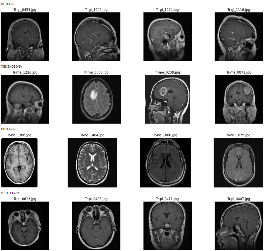 Brain Tumor Detection Model